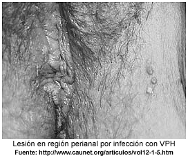 de Papiloma Humano (VPH).