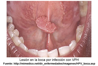 evitar el contagio con VPH